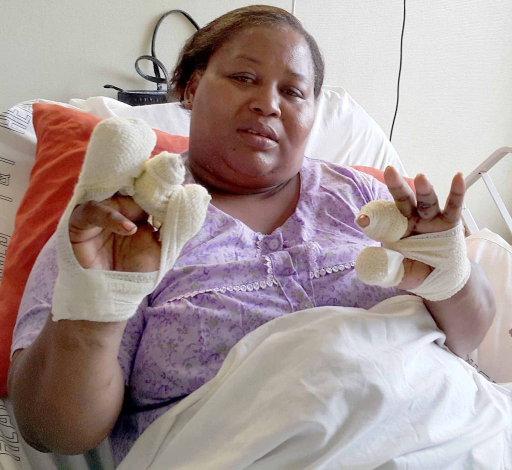 FLASHBACK: Sally-Ann Cuffie of Talparo, shows the injuries she sustained as a result of a stratch bomb attack,
