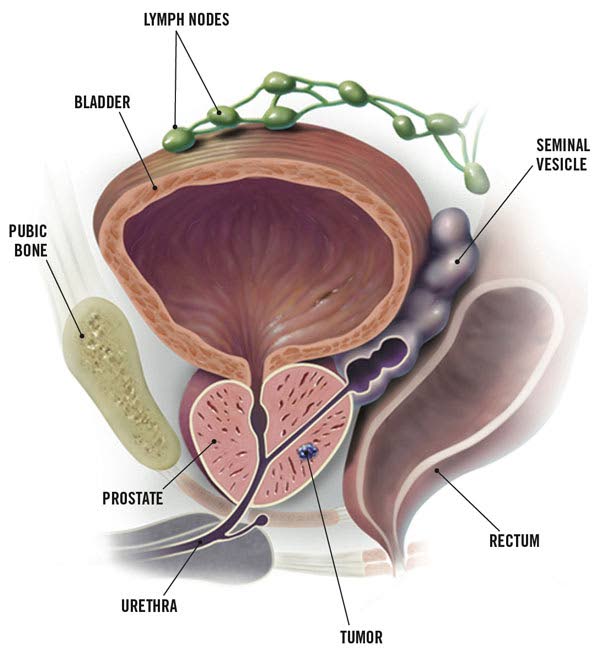 An image showing a stage one cancer tumor in the prostate.