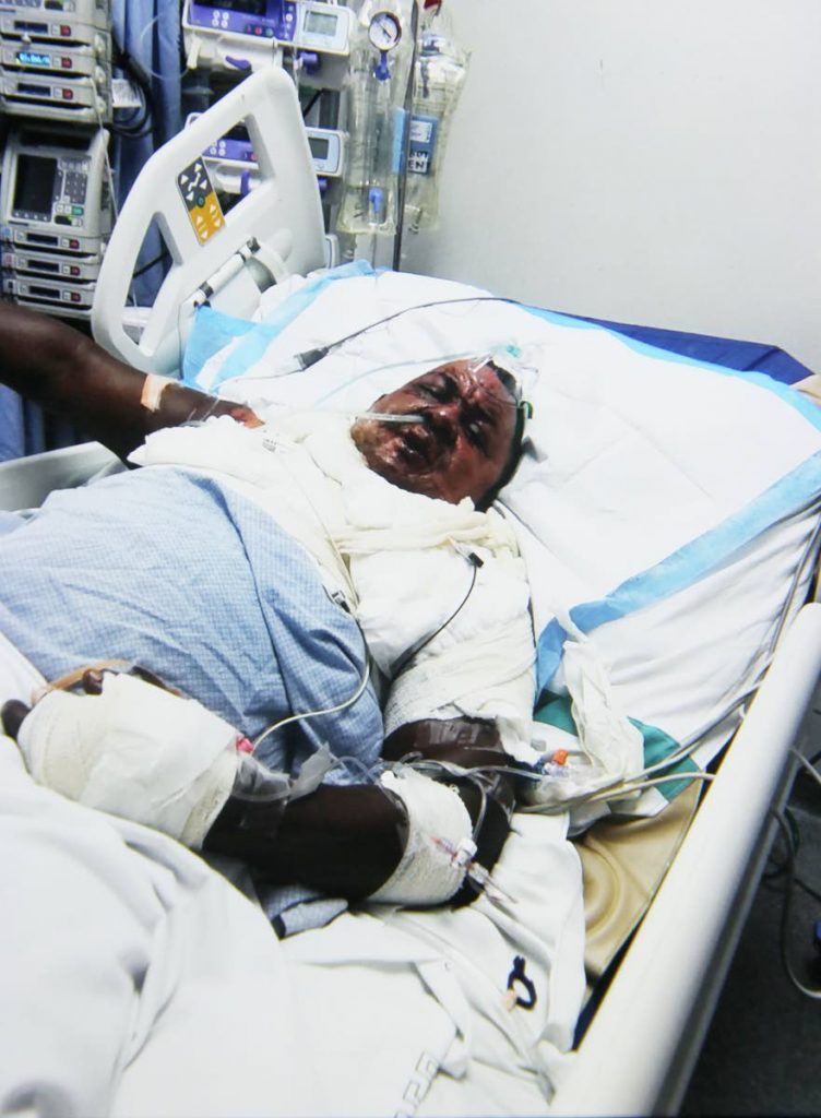 Raymond “Abba” La Fortune, remains in a critical condition at the San Fernando General Hospital after being doused with puncheon and set on fire.