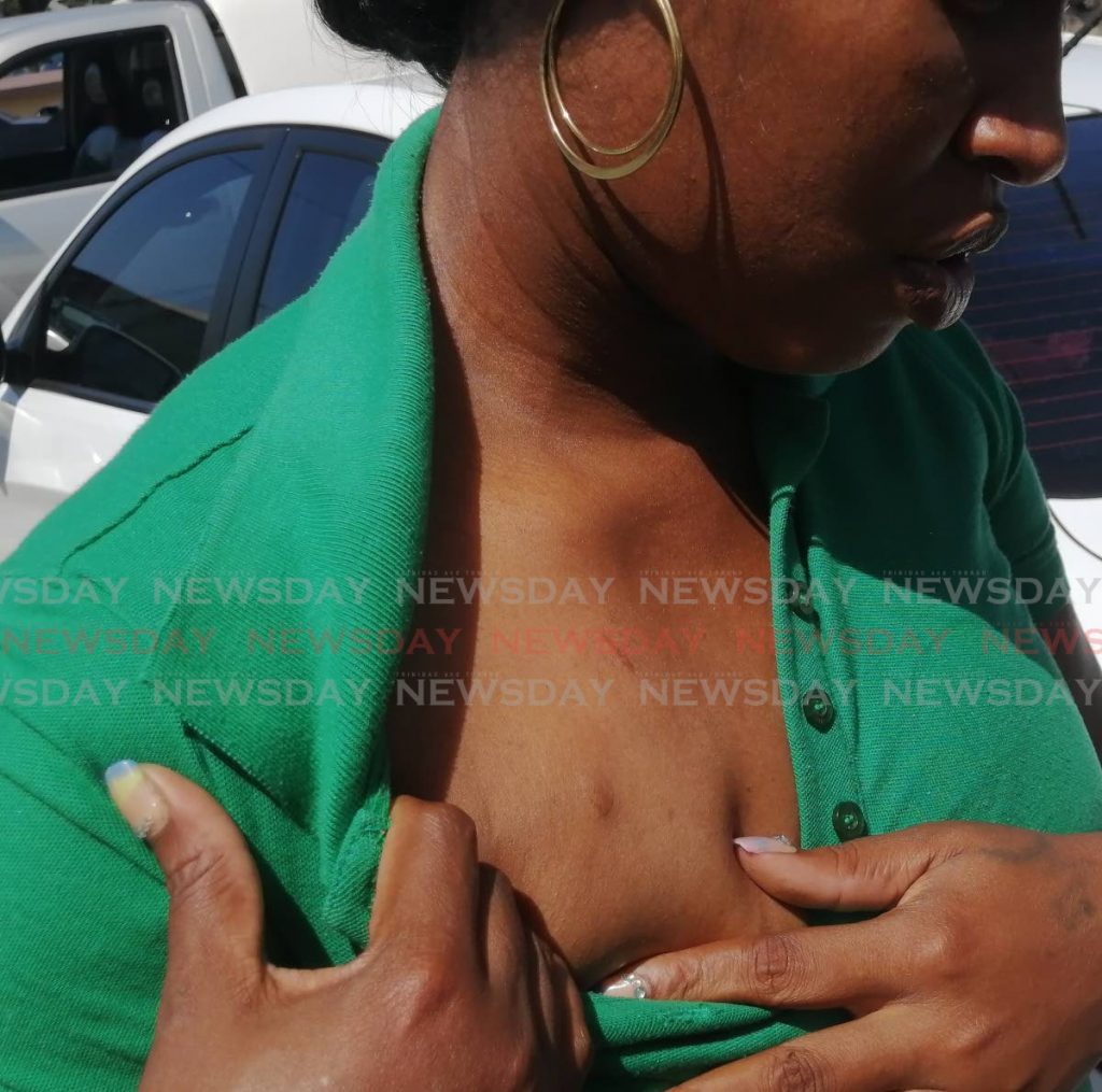 HE DID THIS: Maysonia Thomas shows scars on her chest which she claimed were stab wounds inflicted by Michael Maynard, father of her daughter Mukeisha whom he killed before taking his own life on Sunday. She displayed her wounds on Monday outside the Forensic Science Centre in St James. PHOTO BY RYAN HAMILTON-DAVIS - Ryan Hamilton-Davis