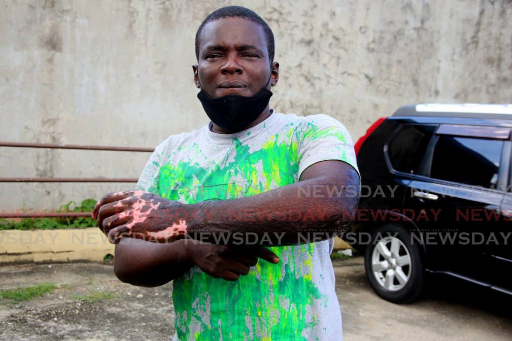 I NEED HELP: Dwayne Alleyne shows the scars on his hand which he suffered over a year ago during an arson attack. He is appealing for a job saying his wife is the only breadwinner in his family. PHOTO BY SUREASH CHOLAI - SUREASH CHOLAI