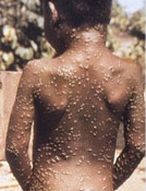 Monkeypox on a child. Image via CDC. 