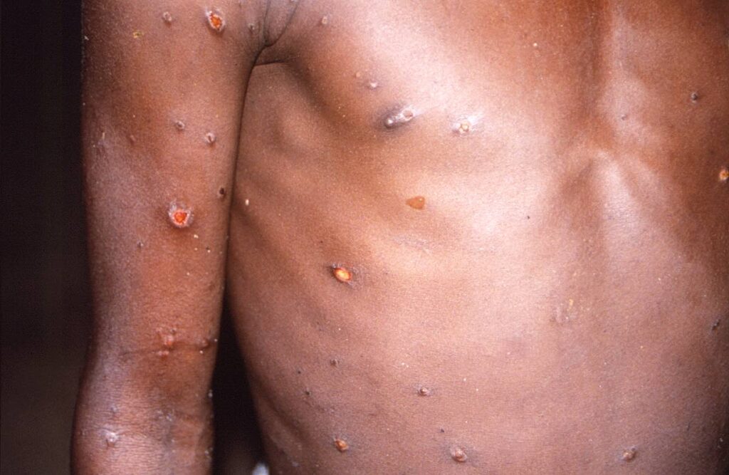 This 1997 image provided by CDC, shows the right arm and torso of a patient, whose skin displayed a number of lesions due to what had been an active case of monkeypox.  - 