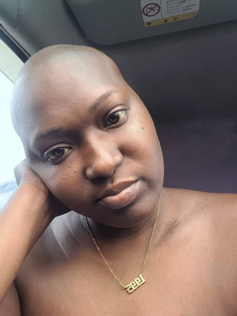 Zelia Christiana Castello suffered hairloss after chemotherapy for cancer.  - 