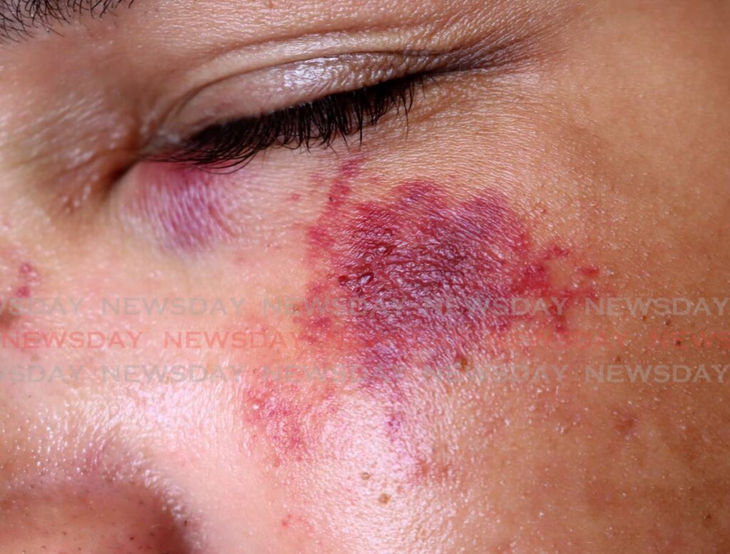 BEATEN: A close-up photo shows the bruises near the eye of this youngster who was beaten by bandits during a home-invasion in Aranguez. There were at least three home-invasions over the past week, with the latest taking place on Tuesday morning in Debe. PHOTO BY ROGER JACOB - 