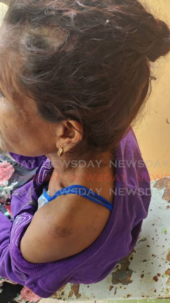 A woman shows bruises she says were inflicted on her by a male relative in Barrackpore on Saturday. A female relative who allegedly severed the man's left hand is in a safe house pending investigations. - File photo/Yvonne Webb