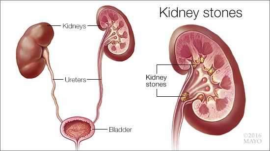 A diagram showing the formation of kidney stones.  - 