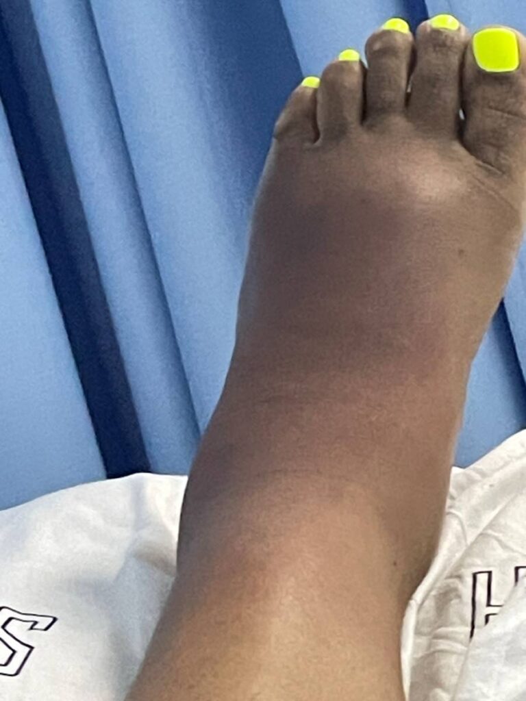 The swollen foot of victim at the Sangre Grande District Hospital. - 